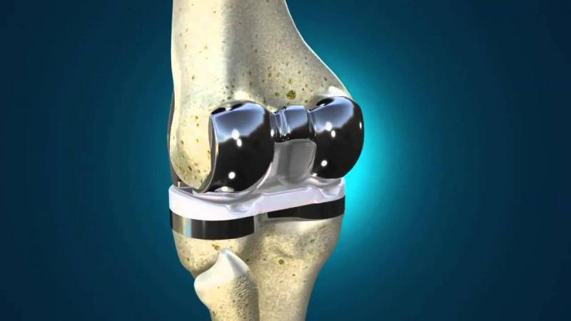 Total Knee Replacement A Patient's Guide Lebanese